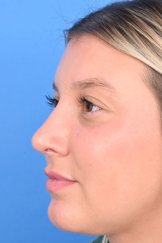 Rhinoplasty Before & After Image