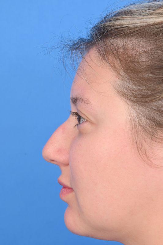 Rhinoplasty Before & After Image
