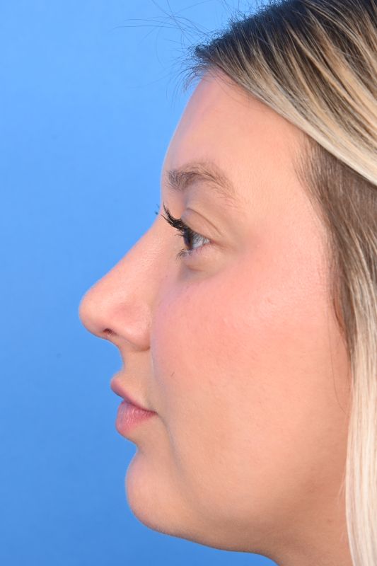 Rhinoplasty Before & After Image