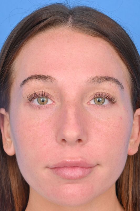 Rhinoplasty Before & After Image