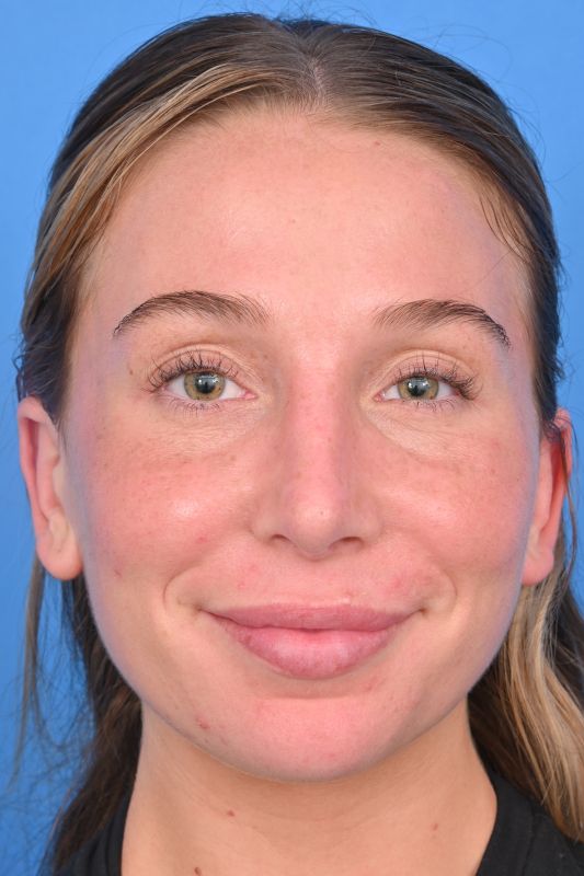 Rhinoplasty Before & After Image
