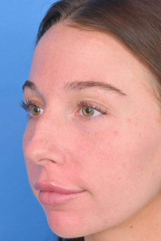 Rhinoplasty Before & After Image