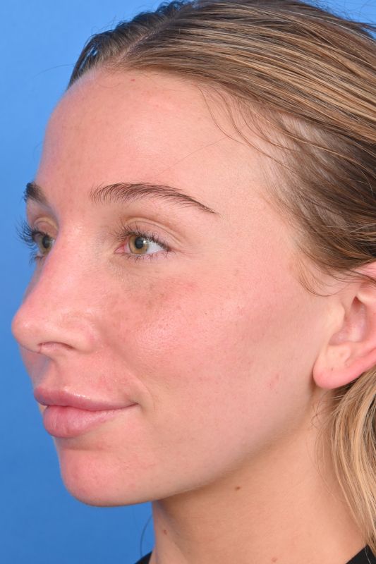 Rhinoplasty Before & After Image