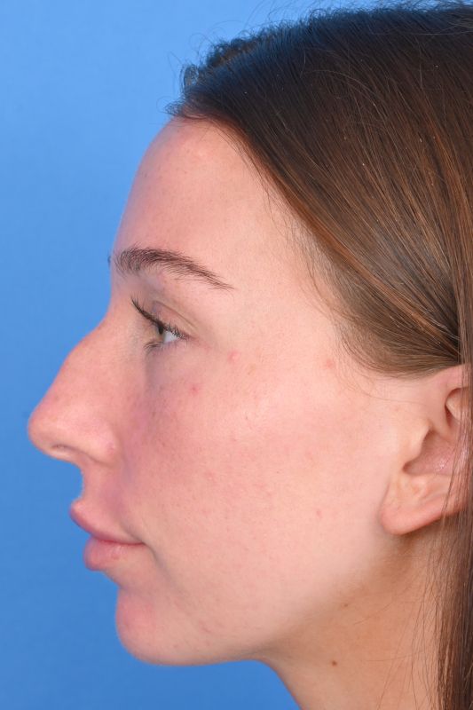 Rhinoplasty Before & After Image