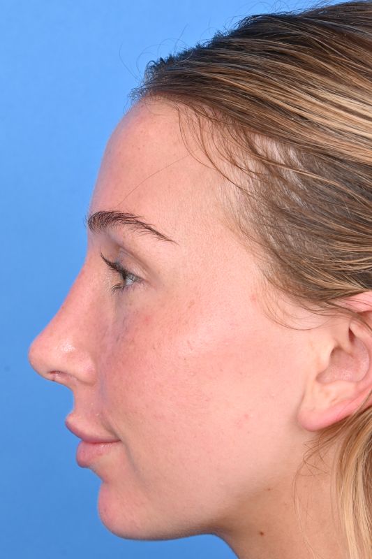 Rhinoplasty Before & After Image