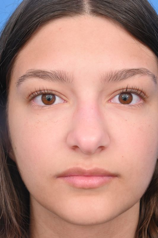 Rhinoplasty Before & After Image