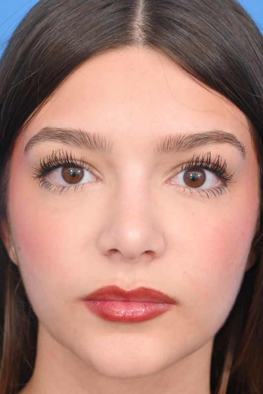 Rhinoplasty Before & After Image