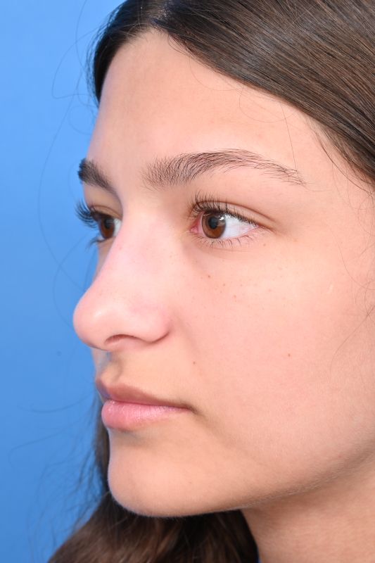 Rhinoplasty Before & After Image