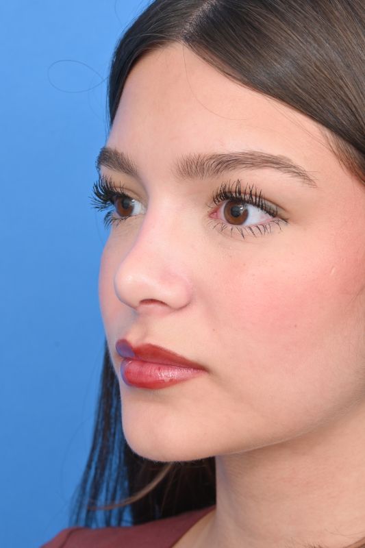 Rhinoplasty Before & After Image