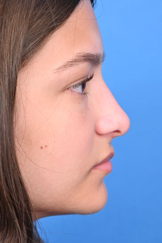 Rhinoplasty Before & After Image