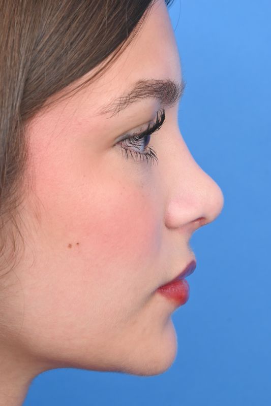 Rhinoplasty Before & After Image