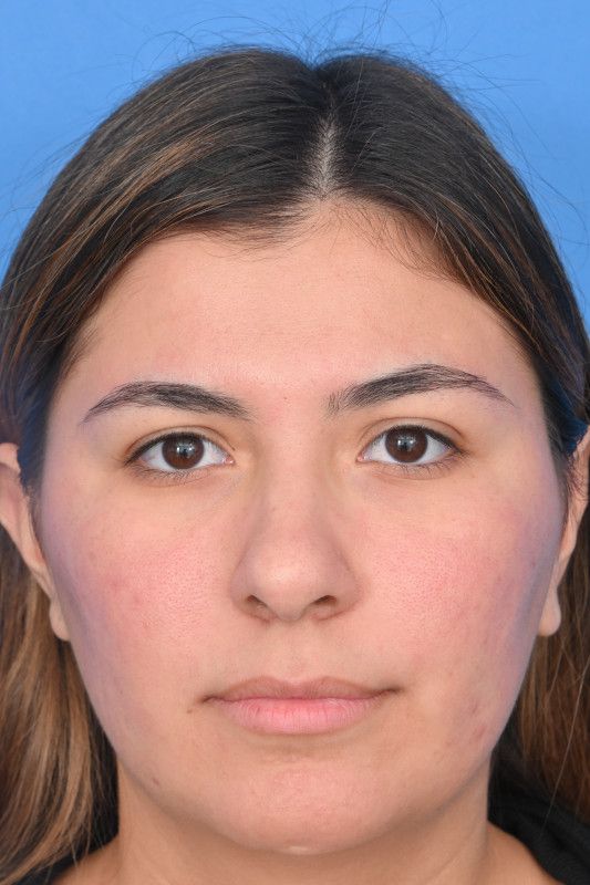 Rhinoplasty Before & After Image