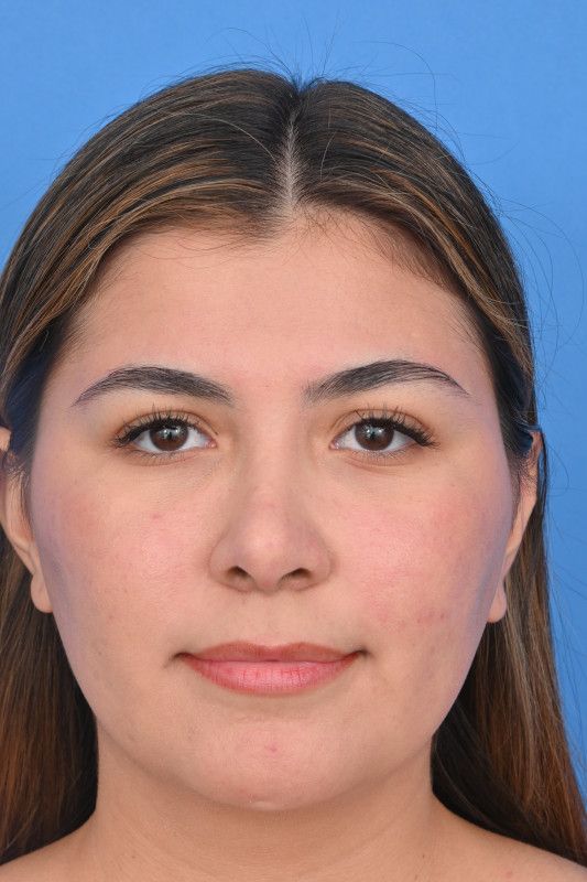 Rhinoplasty Before & After Image
