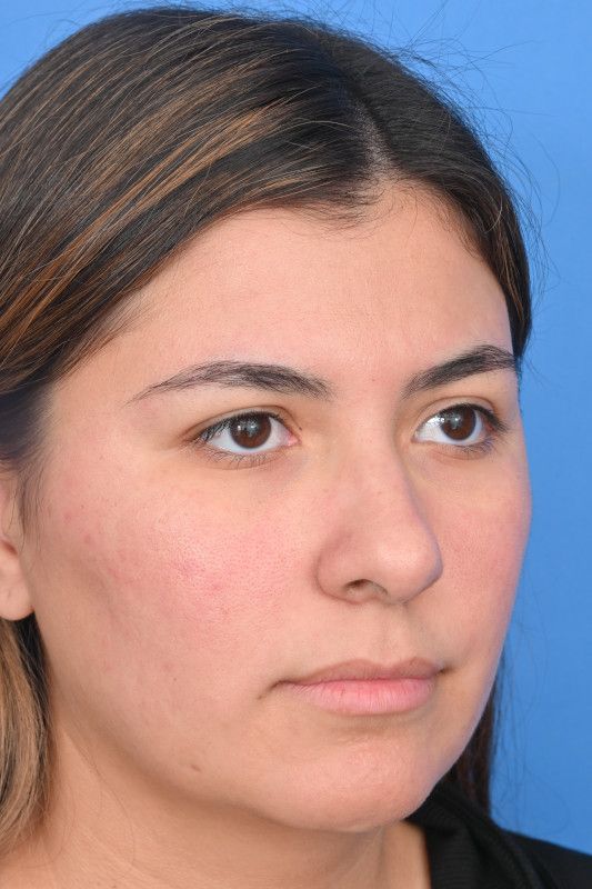 Rhinoplasty Before & After Image