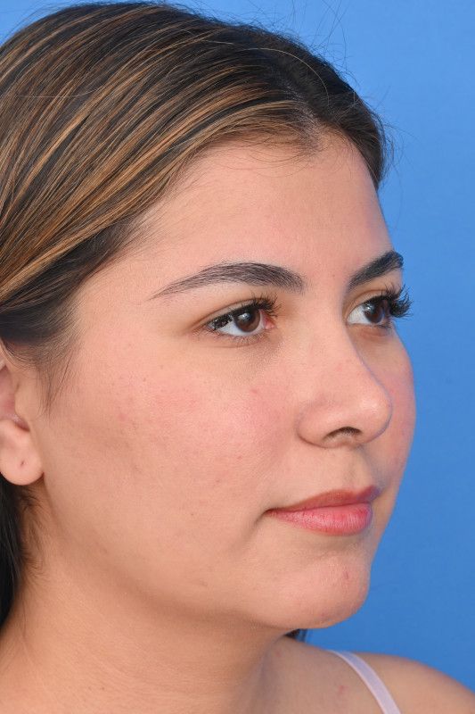 Rhinoplasty Before & After Image