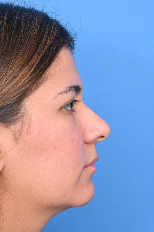 Rhinoplasty Before & After Image