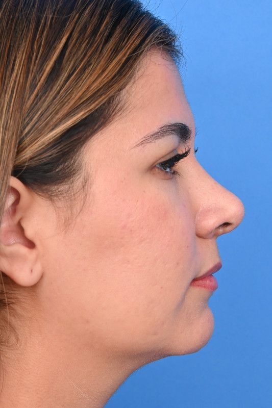 Rhinoplasty Before & After Image