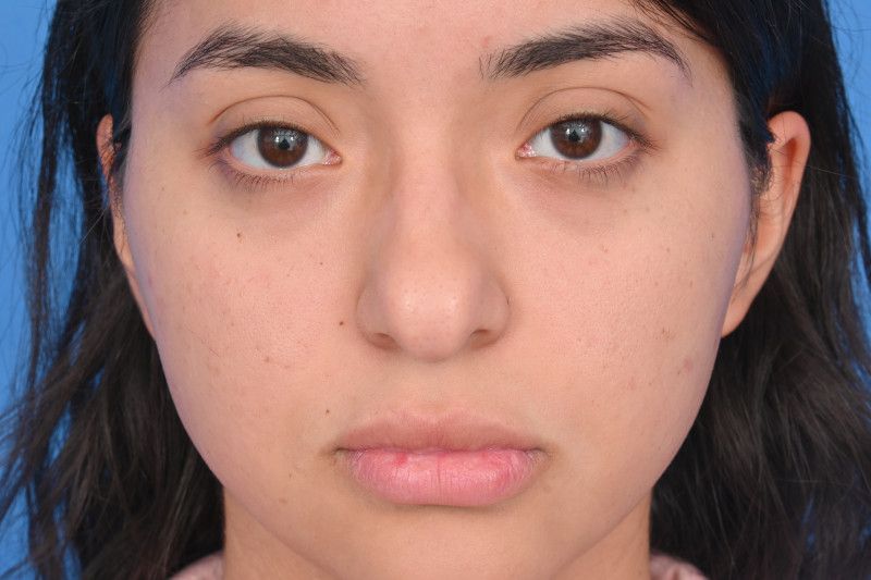 Rhinoplasty Before & After Image