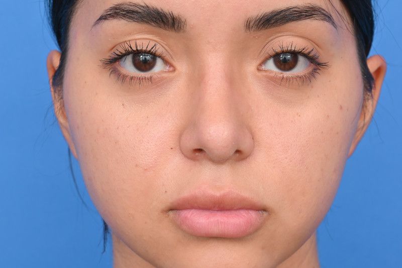 Rhinoplasty Before & After Image