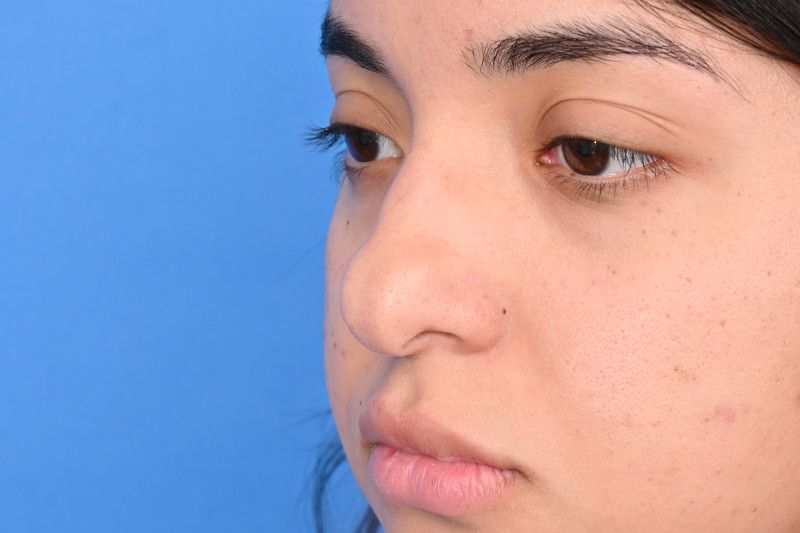 Rhinoplasty Before & After Image