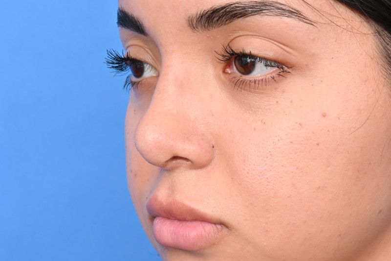 Rhinoplasty Before & After Image