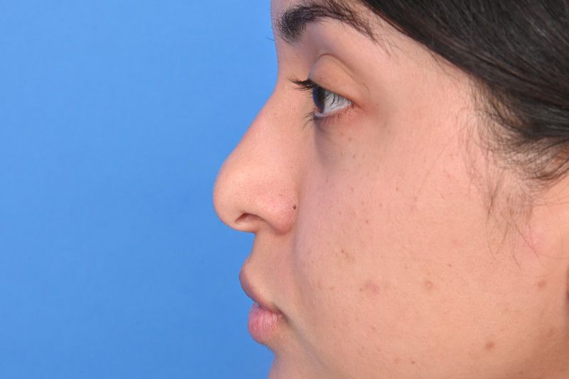 Rhinoplasty Before & After Image
