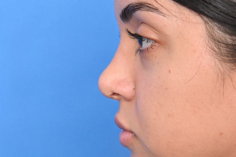 Rhinoplasty Before & After Image
