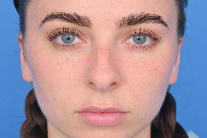 Rhinoplasty Before & After Image