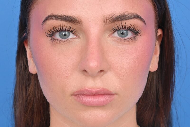 Rhinoplasty Before & After Image