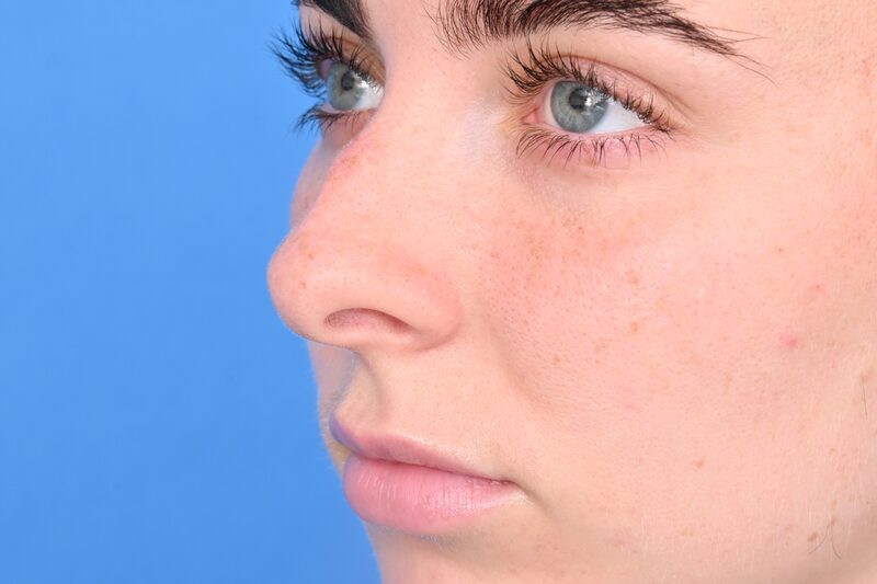 Rhinoplasty Before & After Image