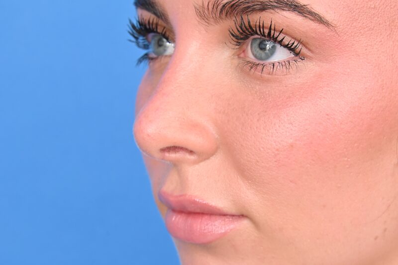 Rhinoplasty Before & After Image