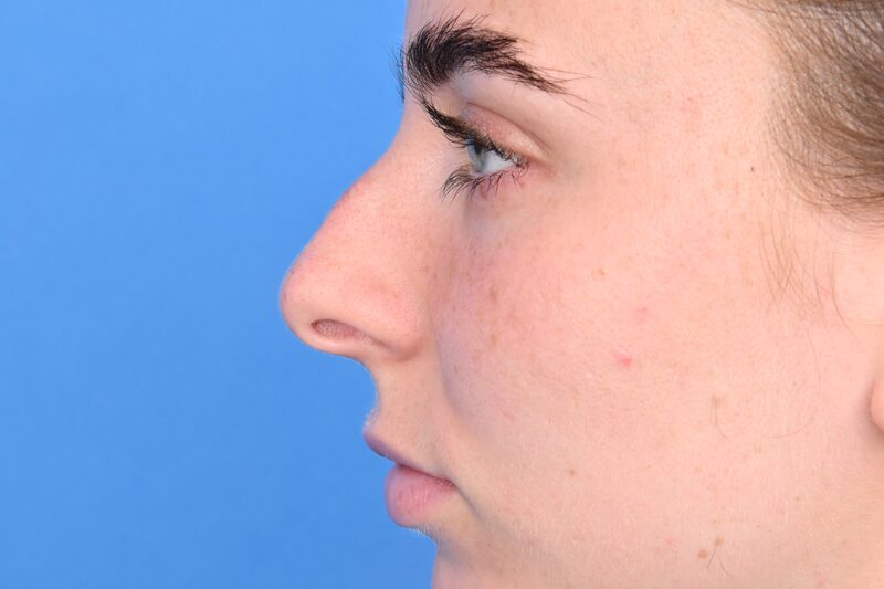 Rhinoplasty Before & After Image