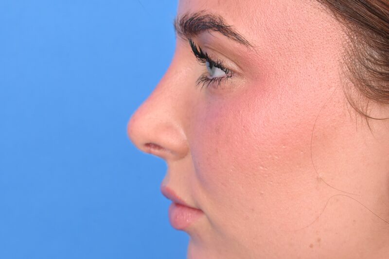 Rhinoplasty Before & After Image