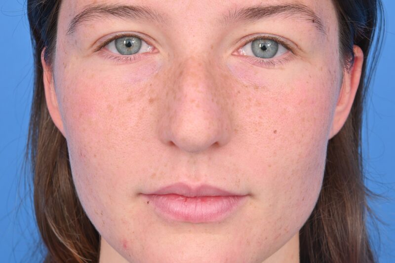 Rhinoplasty Before & After Image