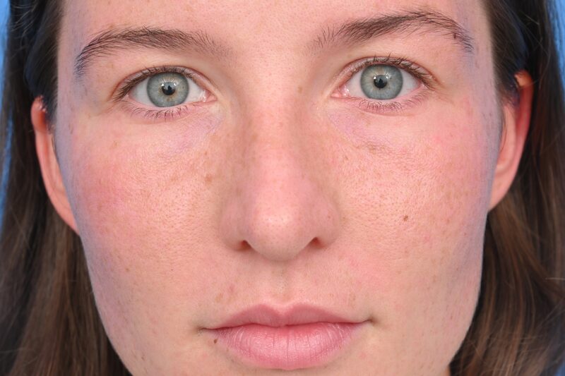 Rhinoplasty Before & After Image