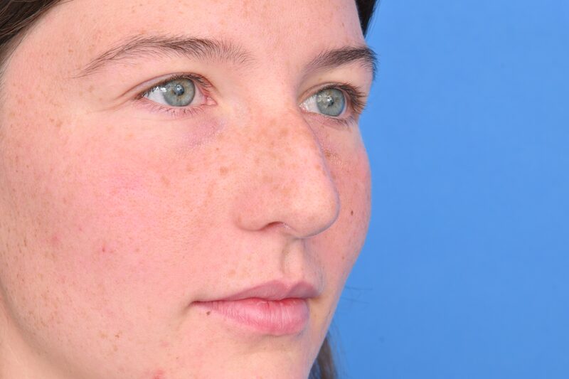 Rhinoplasty Before & After Image