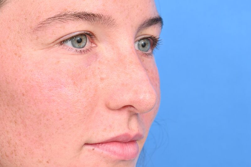 Rhinoplasty Before & After Image