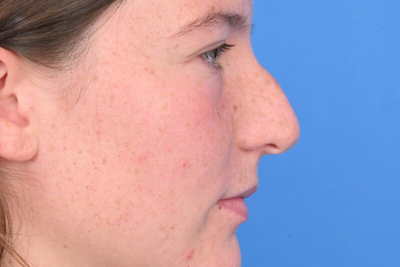 Rhinoplasty Before & After Image