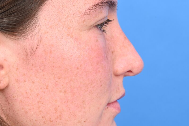 Rhinoplasty Before & After Image
