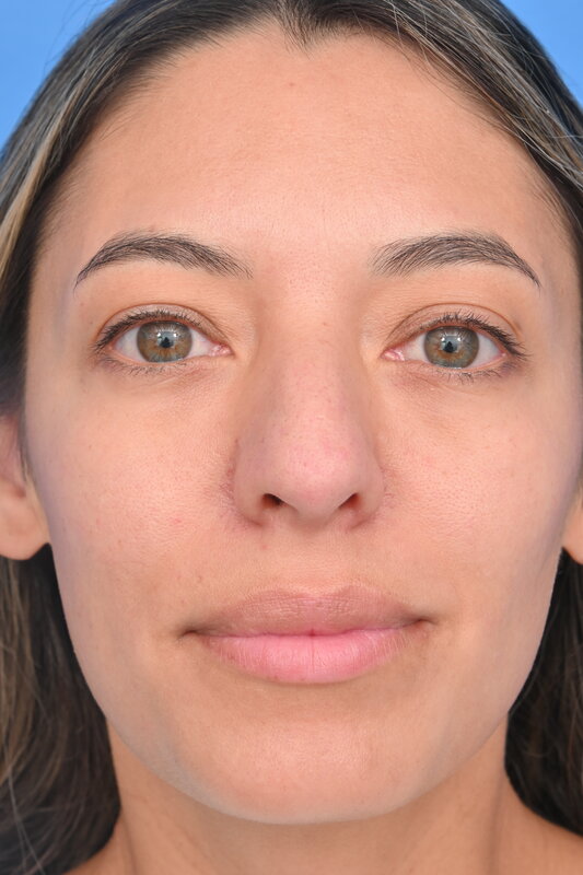 Rhinoplasty Before & After Image