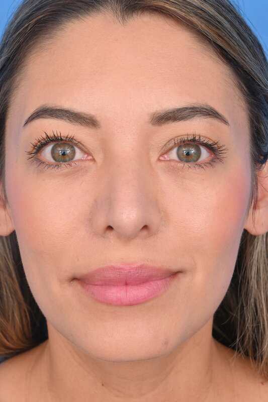 Rhinoplasty Before & After Image