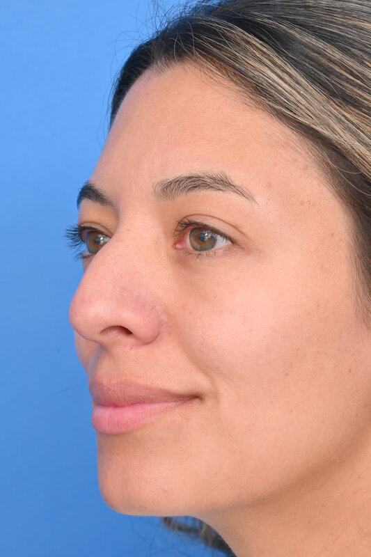 Rhinoplasty Before & After Image