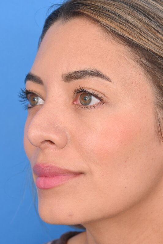 Rhinoplasty Before & After Image