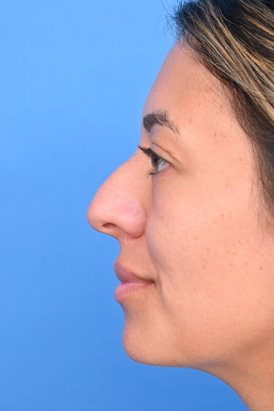 Rhinoplasty Before & After Image