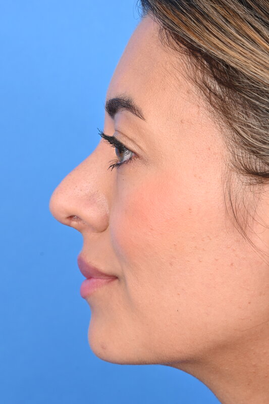 Rhinoplasty Before & After Image